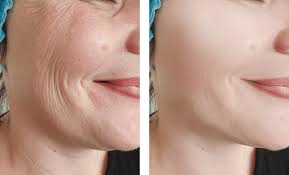 PRP جوان‌سازی پوست کلنیک ونوس -کرج چهارراه طالقانی