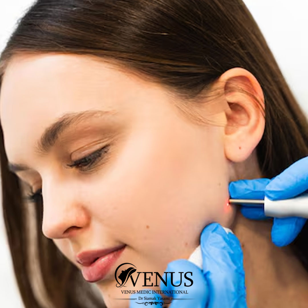 برداشتن خال و کک و مک در کرج