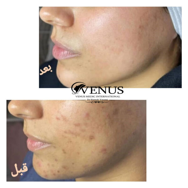 میکرونیدلینگ (Microneedling) میکرونیدلینگ (Microneedling)