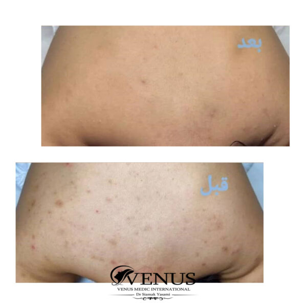 y-25 میکرونیدلینگ