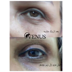 برای رفع گودی زیر چشم چه کنیم؟ انواع درمان خانگی و روشهای پزشکی — دکتریاسمی