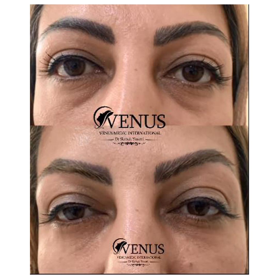 y-34 هایفوتراپی