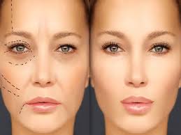 تزریق چربی به صورت و بیکینی -در کلنیک زیبایی ونوس-کرج