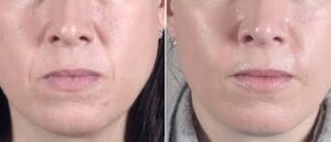 -تزریق چربی به صورت و بیکینی در کلنیک-ونوس-کرج-چهاراه طالقانی