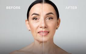 - تزریق چربی به صورت و بیکینی کلنیک ونوس در کرجچهارراه طالقانی-