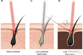 لیزر موهای زائد کلینیک ونوس کرج -چهارراه طالقانی