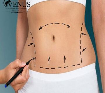 لیپوماتیک در کرج