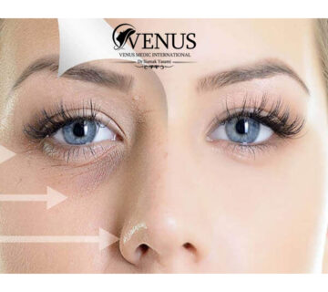 مزوژل زیر چشم در کرج