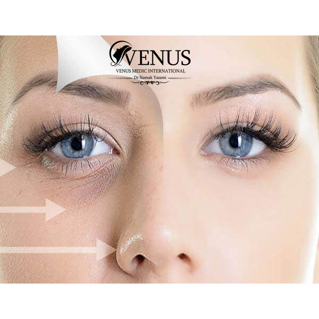 مزوژل زیر چشم در کرج