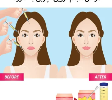 تزریق چربی به صورت