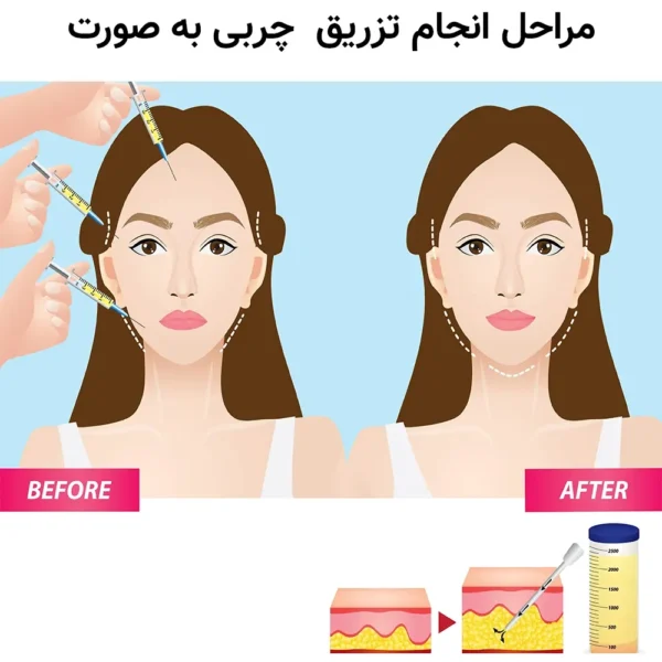 fat-grafting-process-e1706456192919 تزریق چربی به صورت