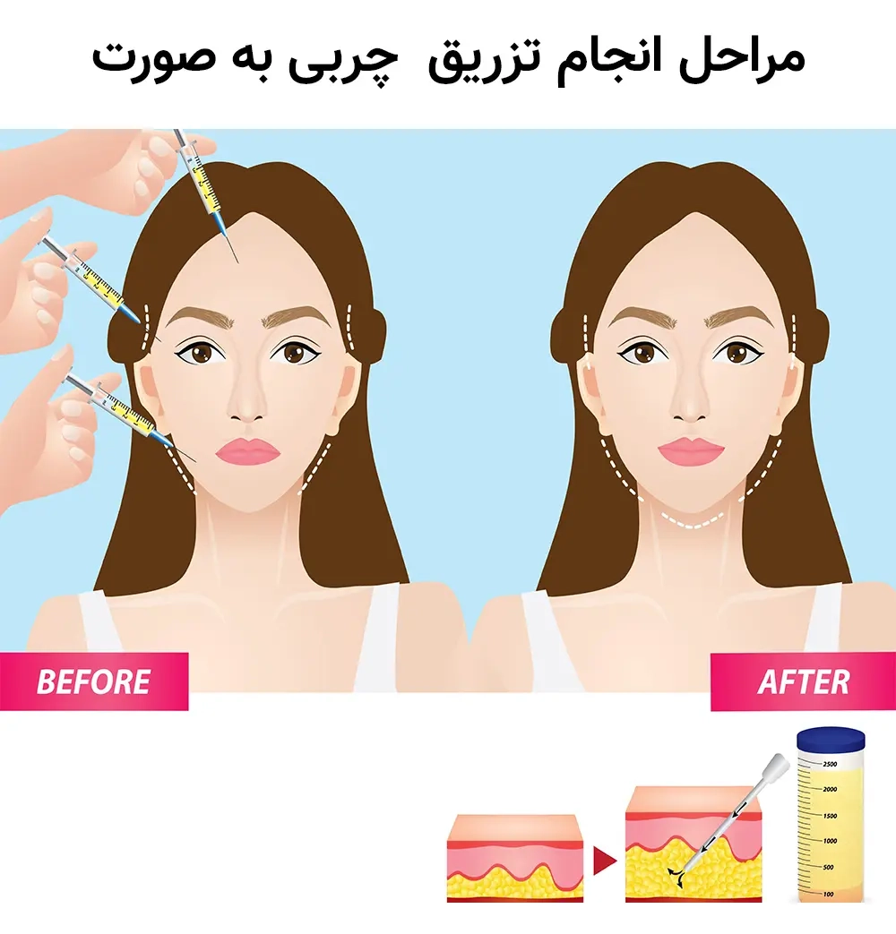 تزریق چربی به صورت