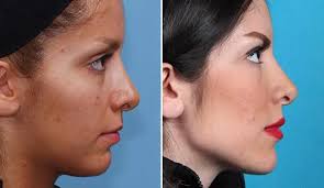 زاویه سازی صورت