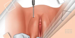 تزریق چربی به بیکینی در کلینیک ونوس