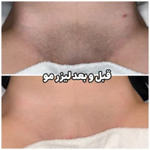 لیزر موهای زائد در کرج