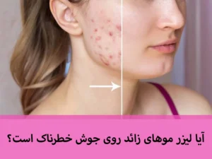 لیزر موهای زائد در کرج