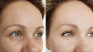 بازگشت جوانی با مزوژل جالپرو