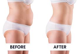 -مزوتراپی-لاغری در کلنیک ونوس کرج