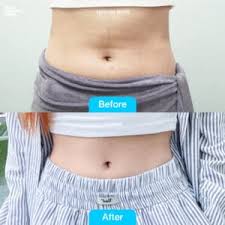 مزوتراپی-لاغری در کلنیک ونوس کرج-طالقانی-مهرشهر-رجایشهر-جهانشهر