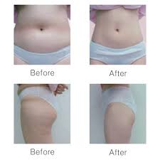 مزوتراپی-لاغری در کلنیک ونوس کرج طالقانی