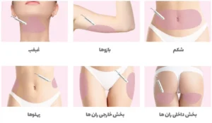 مزوتراپی لاغری و تاثیر آن در چربی سوزی بدن