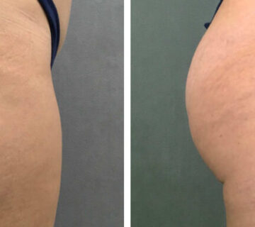 پرولیفت صورت و بدن در کرج 