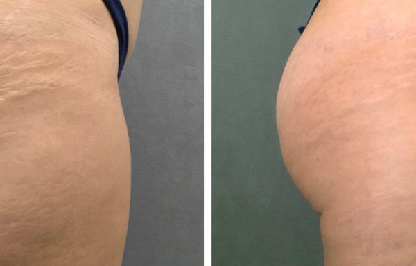 پرولیفت صورت و بدن در کرج 