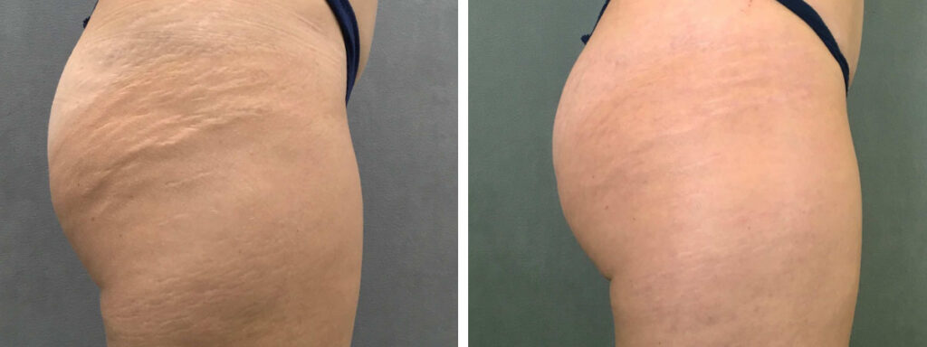 پرولیفت صورت و بدن در کرج