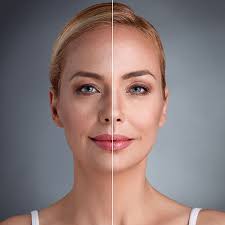 پرولیفت صورت و بدن در کرج - بدون جراحی-کلنیک ونوس