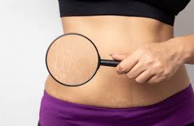 رفع ترک های پوستی-کلنیک -زیبایی -ونوس-کرج