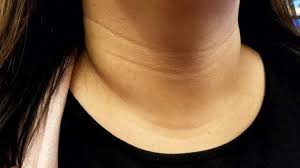 رفع خطوط -گردن-کلنیک -زیبایی -ونوس