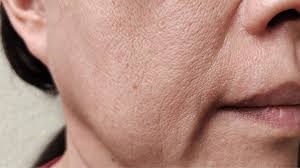 لیفت افتادگی پایین صورت (sagging)